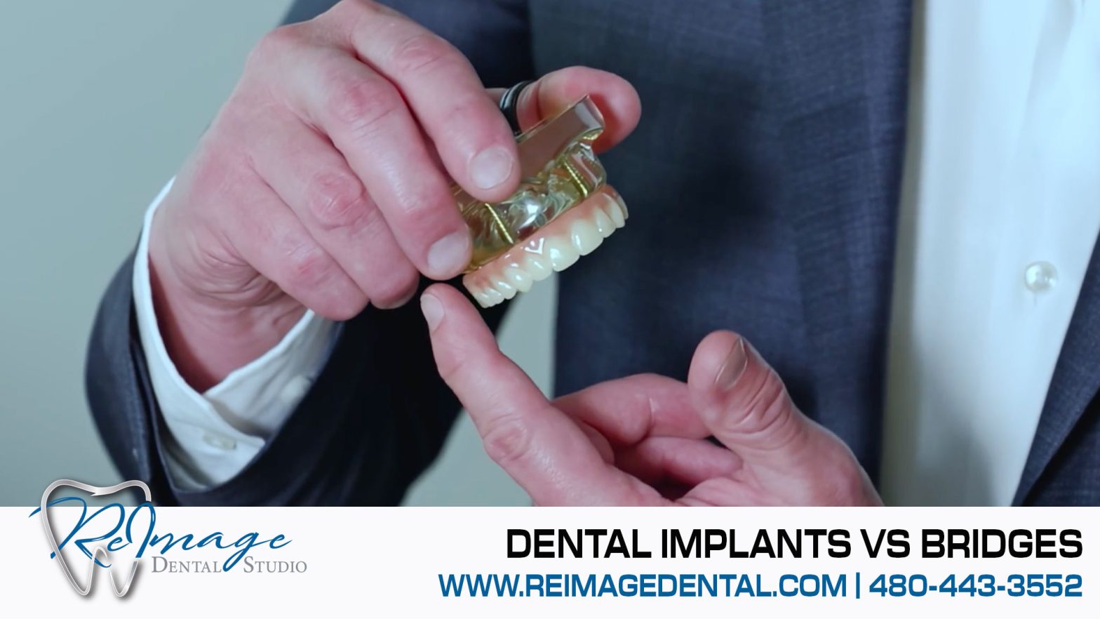 dental implants VS bridges | ReImage Dental Studio