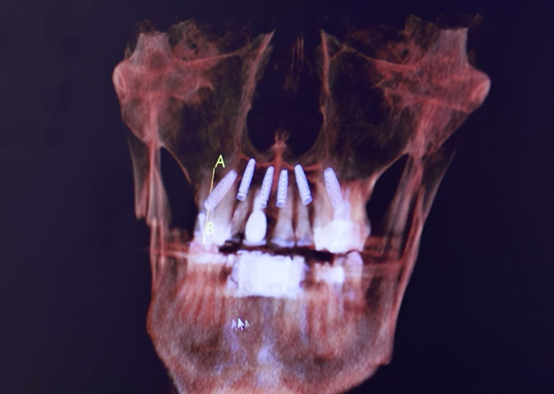 Dental Implants | ReImage Dental Studio | Scottsdale Dentist Dental Implants | ReImage Dental Studio | Scottsdale Dentist